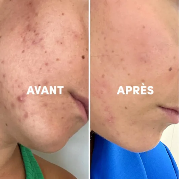 Complexe alimentaire Peau Nette Acnés & Imperfections - WAAM - Image 3